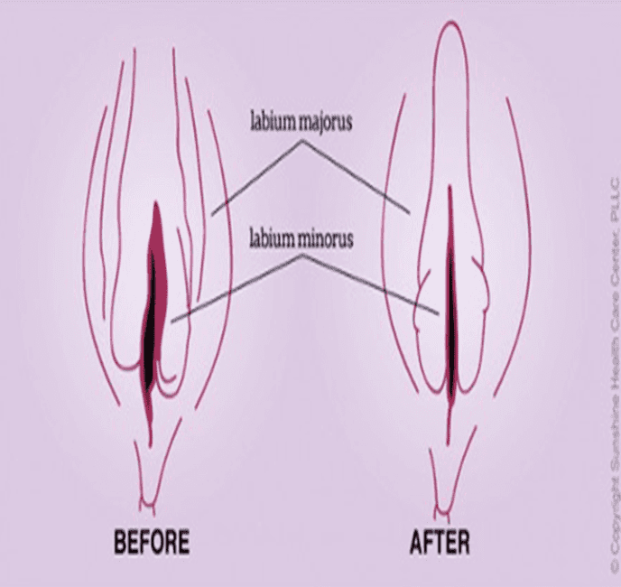 Vaginal Rejuvenation